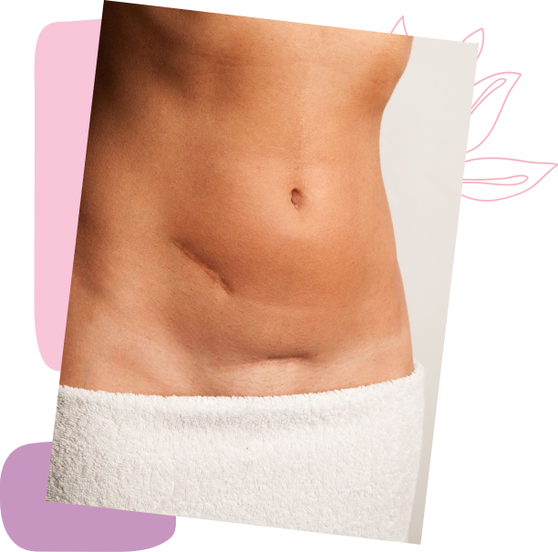 stomach laser hair removal