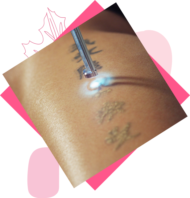 laser tattoo removal near me