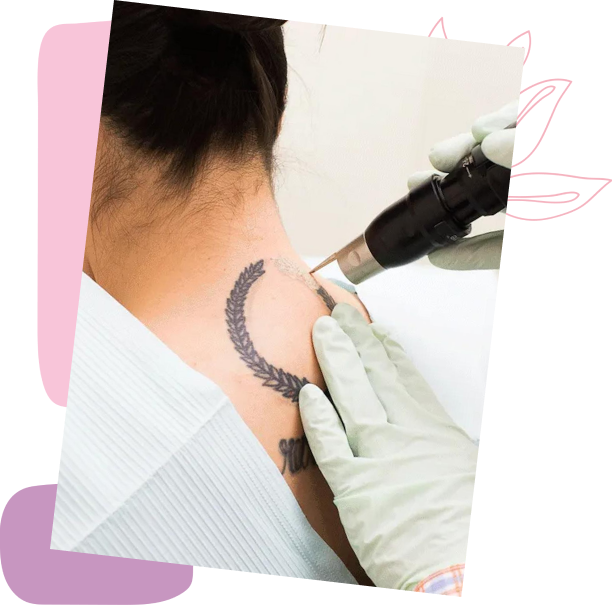 picosure tattoo removal 