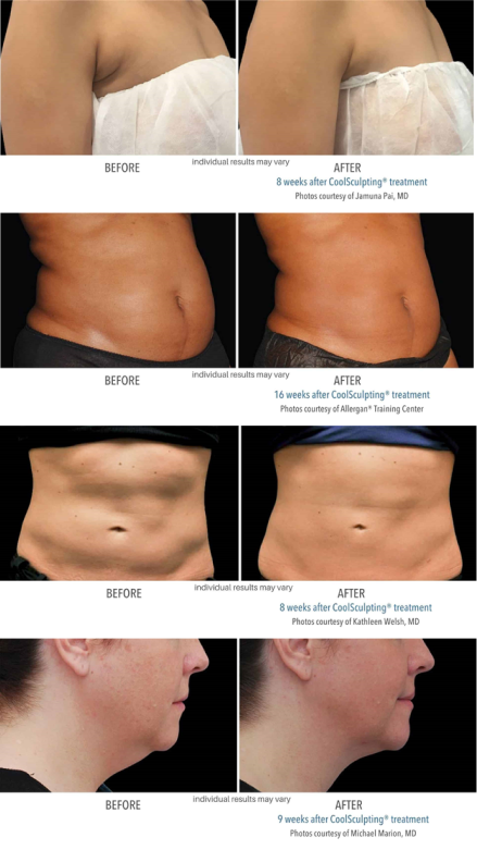 Coolsculpting Elite Before and After