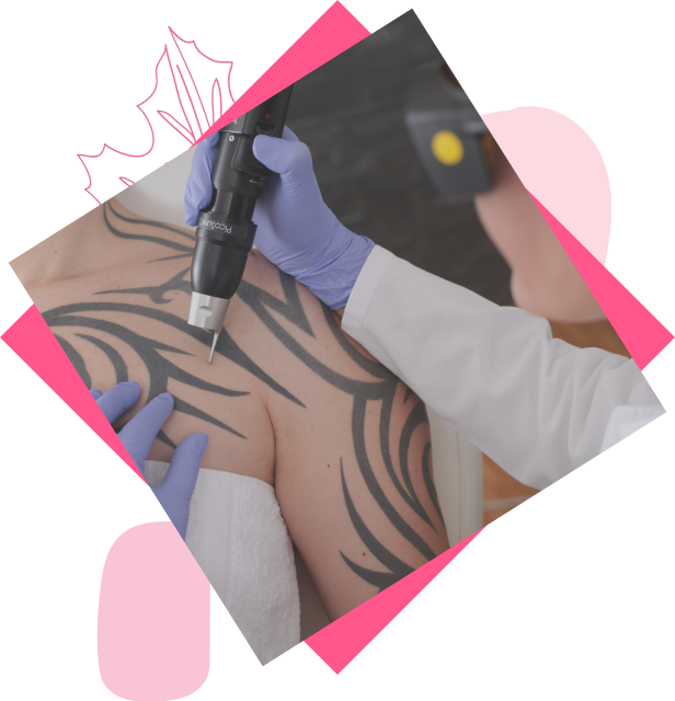 picosure tattoo removal 